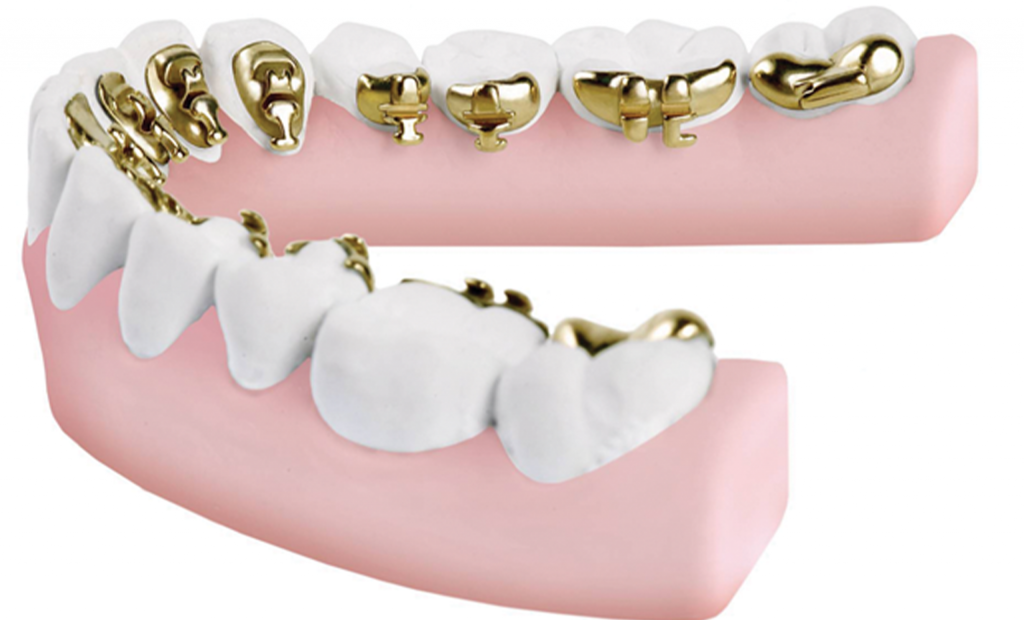 teeth model having indirect bonding