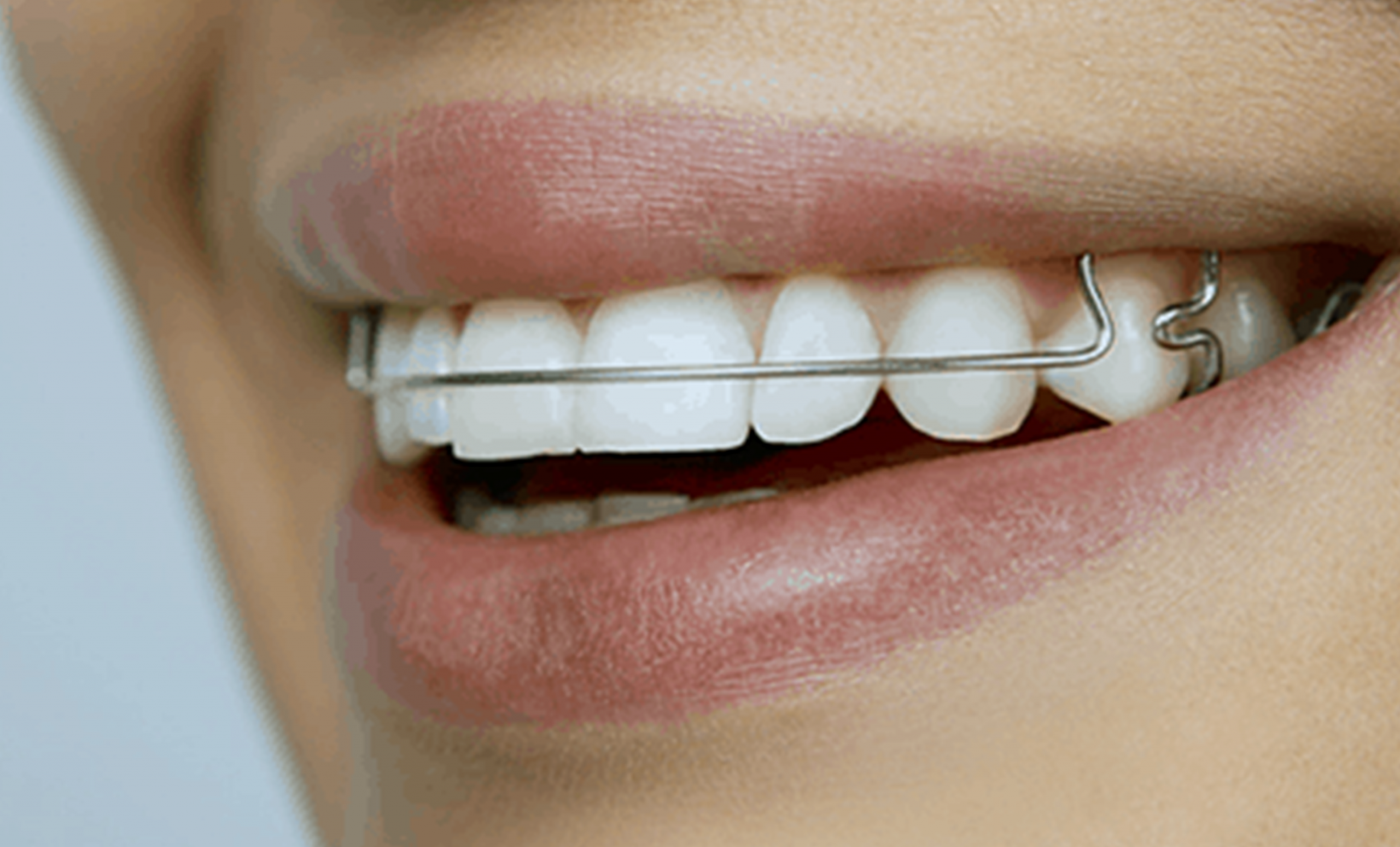 The importance of retainers, from Dr. Whitlock