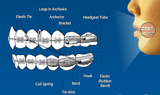 What Is An Orthodontic Tie Wire On Braces? - ArchWired