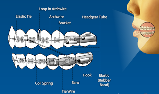 Help!! Rubber band won't hook : r/braces