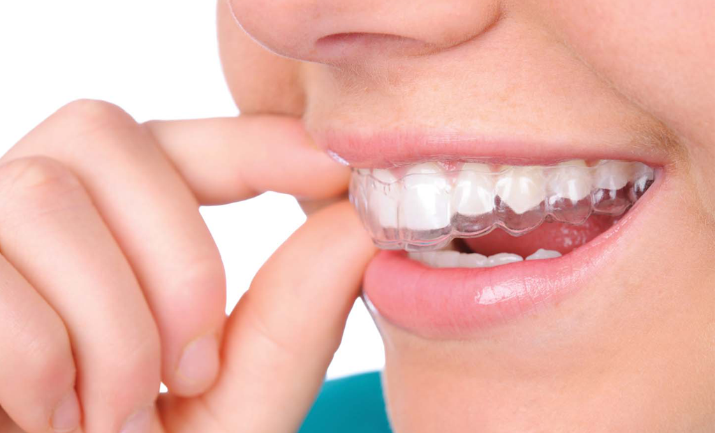 person wearing clear aligners
