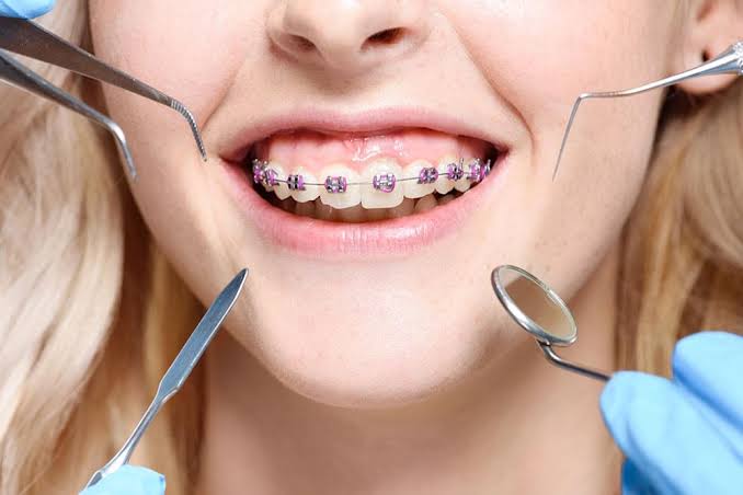 Braces In Charlotte Nc Orthodontist