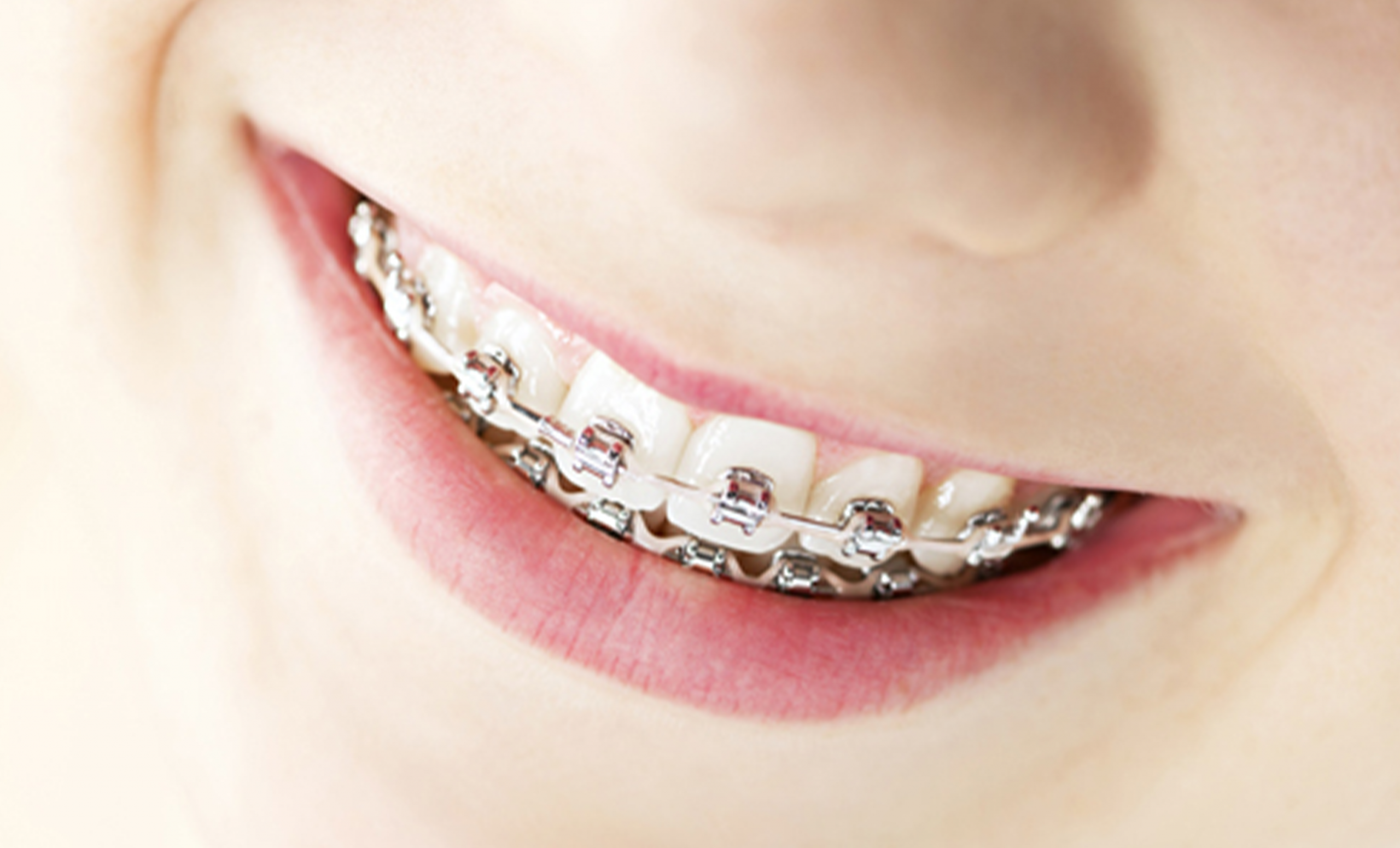 Besides straight teeth, what are the benefits of braces?