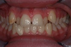 teeth misalignment