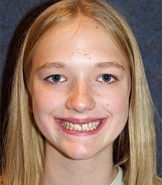 girl with teeth disorder