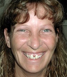 woman with a teeth disorder