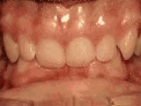 deep overbite teeth disorder