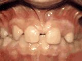 teeth disorder