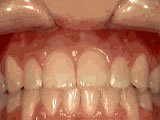 openbite teeth disorder