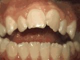 open bite teeth disorder