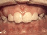 overbite teeth disorder