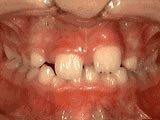 teeth with disorder