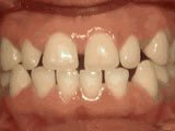 space of the teeth disorder