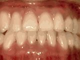underbite teeth disorder