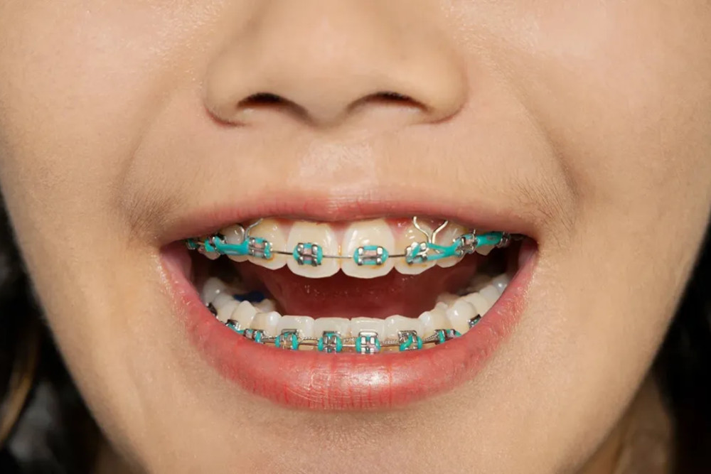 Elastics for Braces – Everything You Need to Know