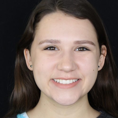 girl showing her perfectly aligned teeth after using teeth invisalign